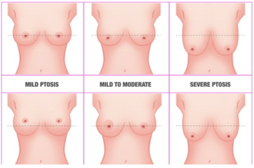 Do I Need A Breast Lift Or Just An Augmentation?