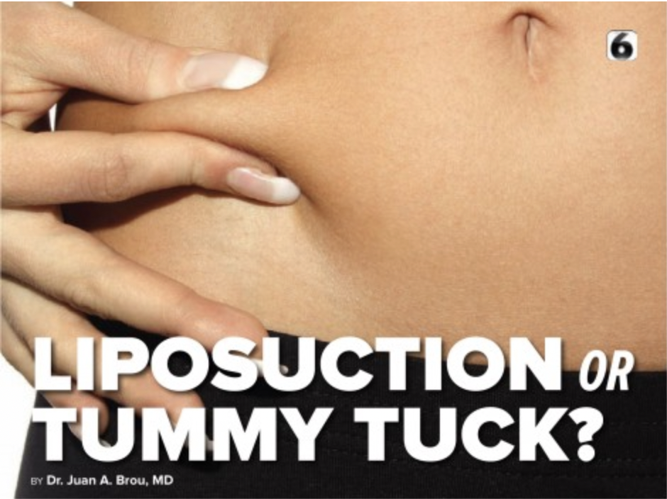 So6ix Magazine: Dr. Brou helps compare liposuction and a tummy tuck procedure