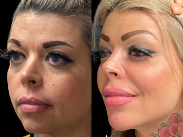 Dermal Fillers