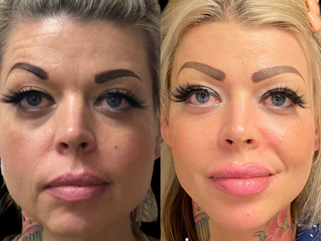 Dermal Fillers