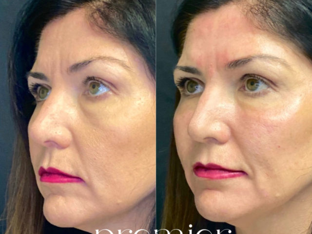 Dermal Fillers