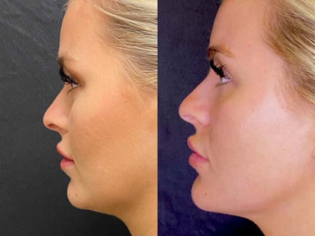 Dermal Fillers