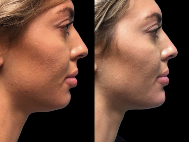 Dermal Fillers