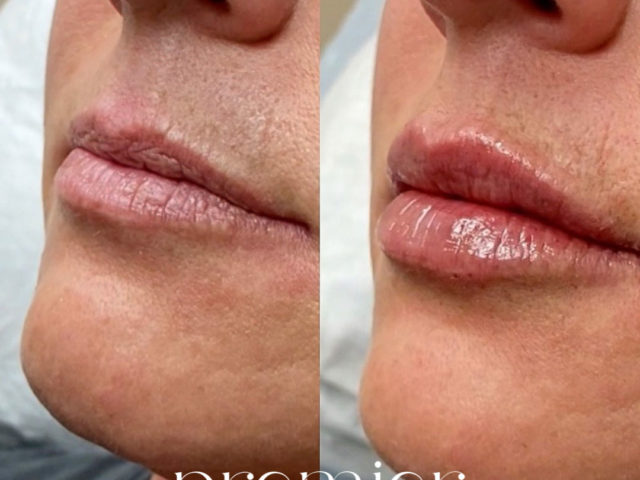 Dermal Fillers