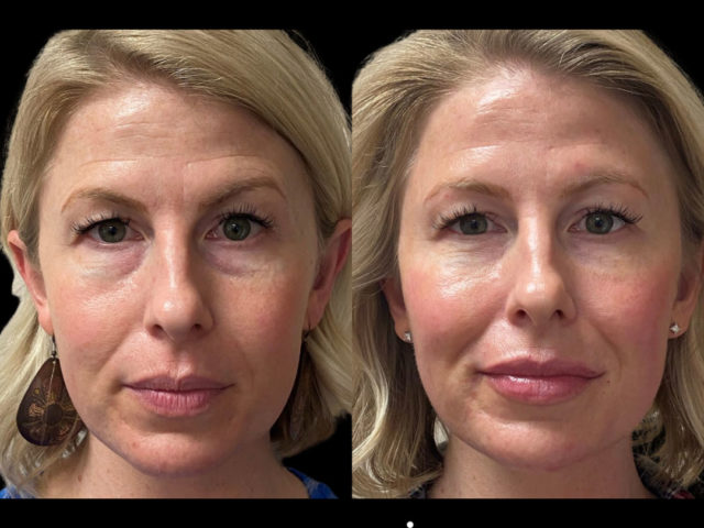 Dermal Fillers