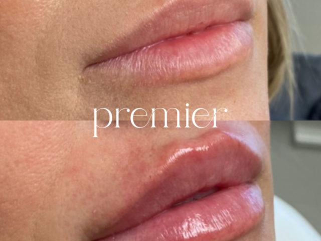 Dermal Fillers