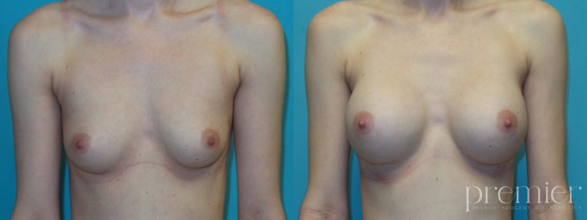 Breast Augmentation