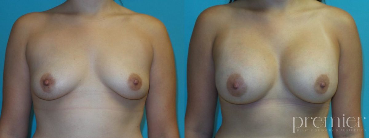Breast Augmentation(2)