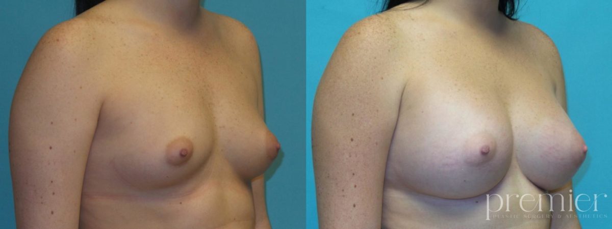 Breast Augmentation(3)