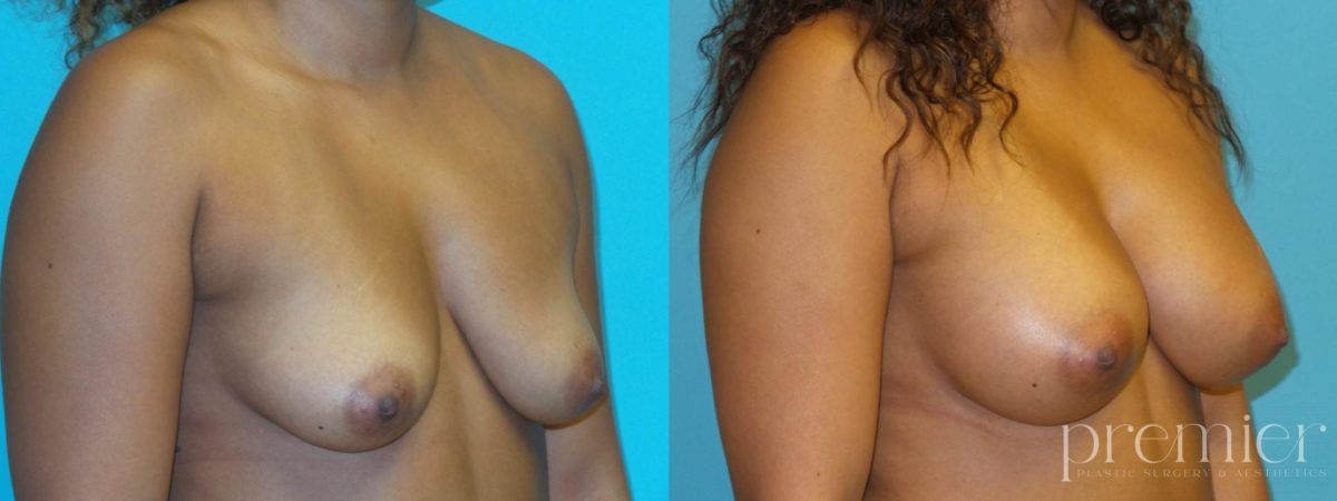 Breast Augmentation(4)