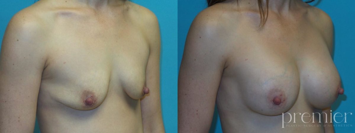 Breast Augmentation(5)