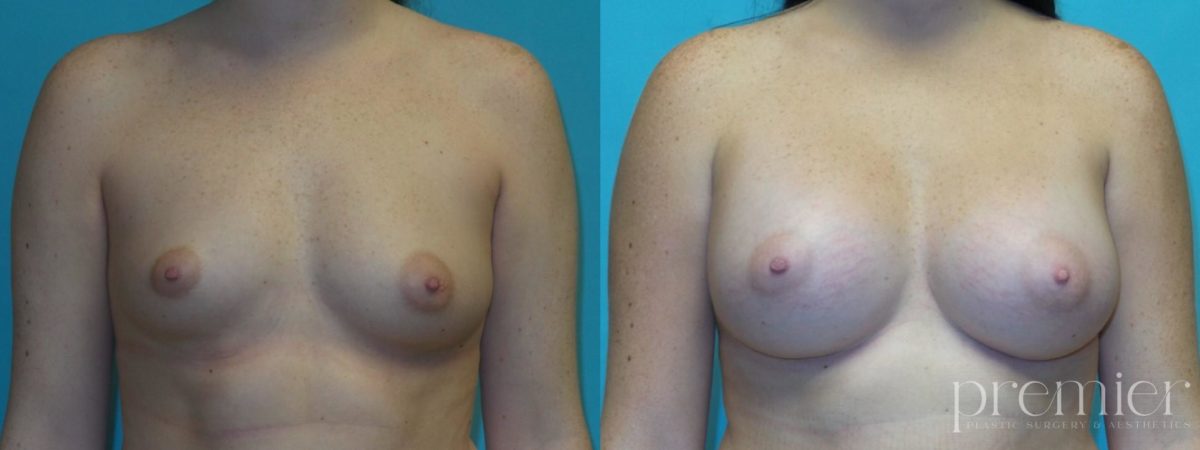 Breast Augmentation(6)