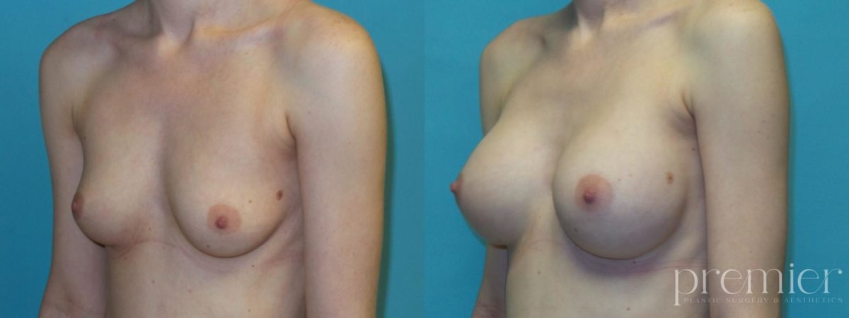 Breast Augmentation(8)