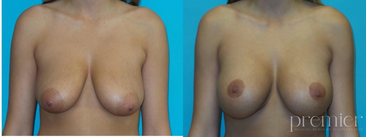 Breast augmentation with Mastopexies