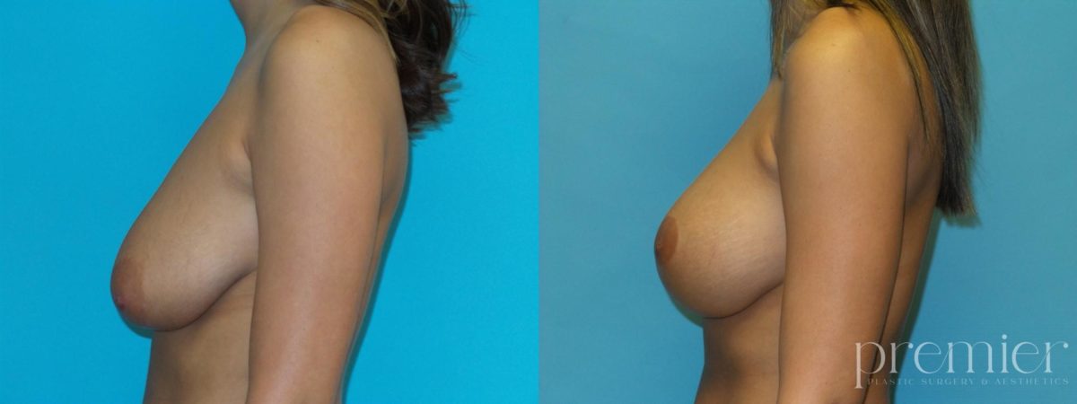 Breast augmentation with Mastopexies (1)