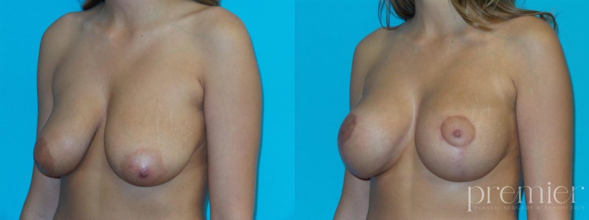 Breast augmentation with Mastopexies