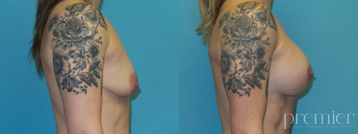 Breast augmentation with Mastopexies RE