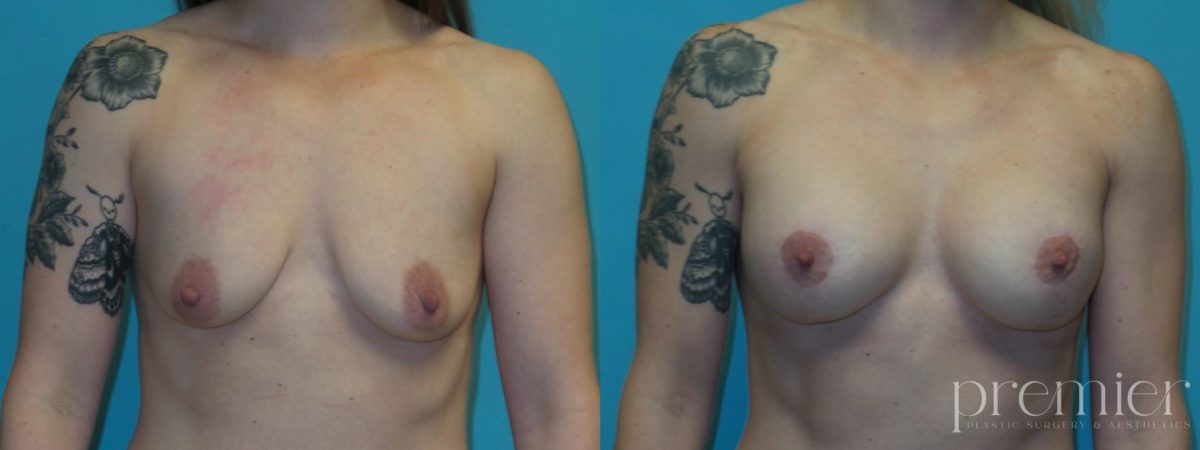 Breast augmentation with Mastopexies RE (1)