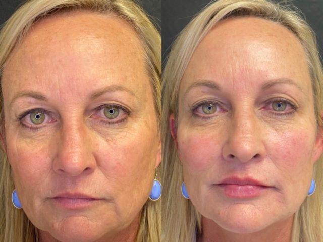 Dermal Fillers