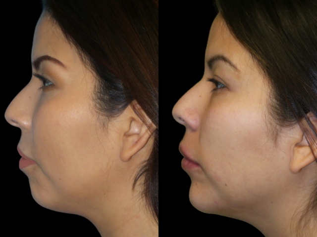 Dermal Fillers