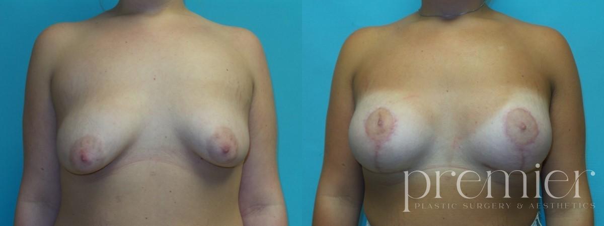 P. Breast augmentation with Mastopexies