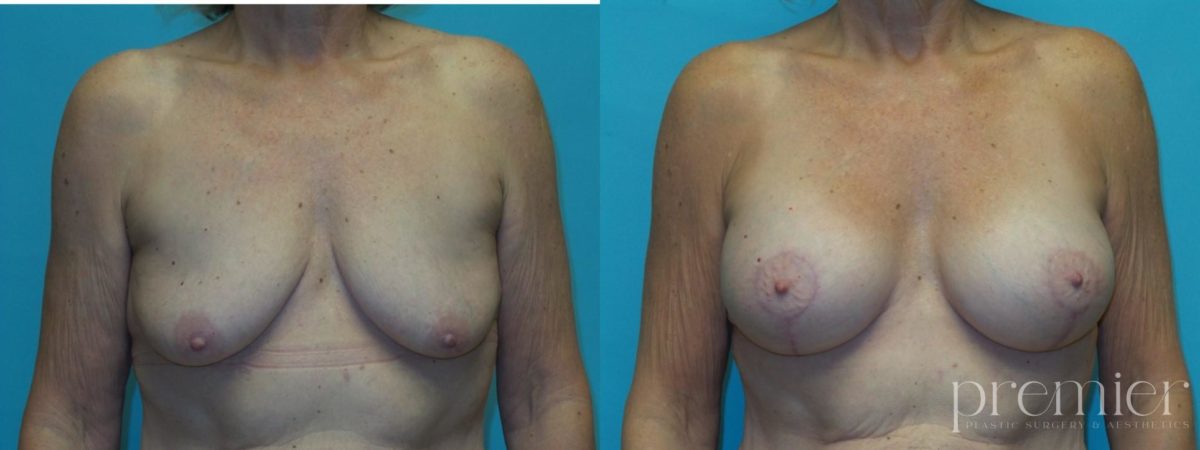 R. Breast augmentation with Mastopexies