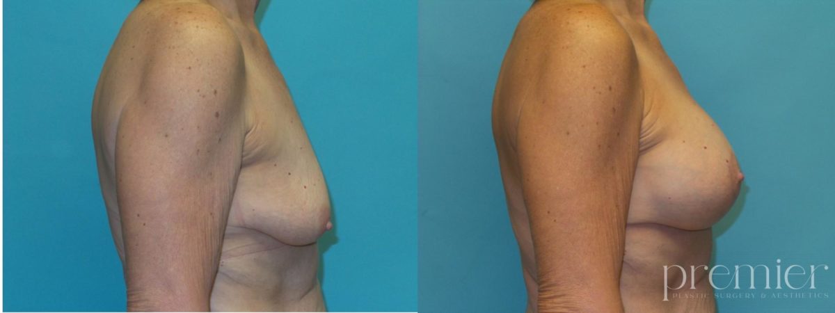 R. Breast augmentation with Mastopexies (1)