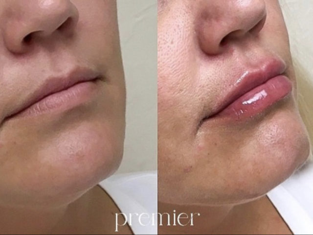 Dermal Fillers