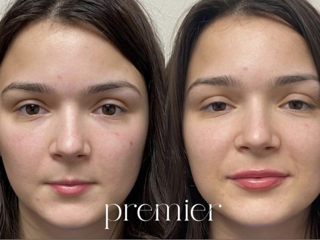 Dermal Fillers