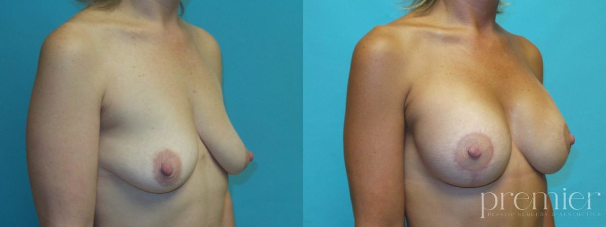 kd Breast augmentation with Mastopexies