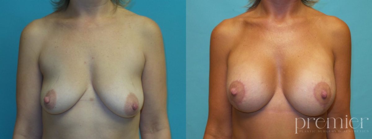 kd2 Breast augmentation with Mastopexies