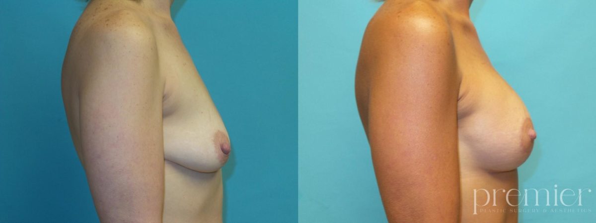 kd3 Breast augmentation with Mastopexies