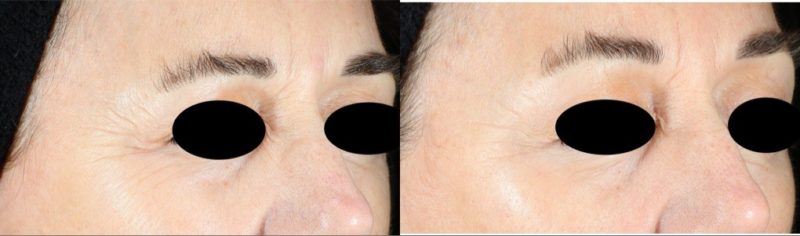 Radio Frequency MicroNeedling