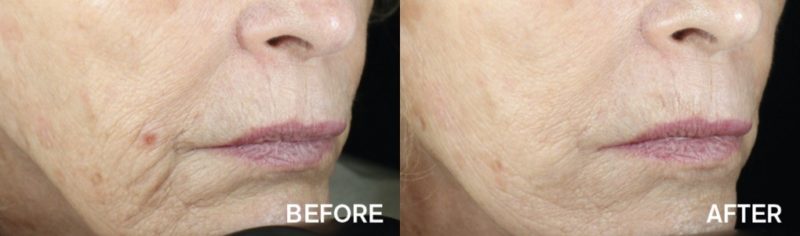 Radio Frequency MicroNeedling