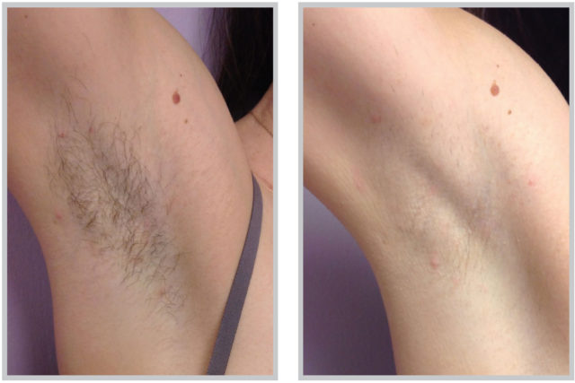 Laser Hair Removal BARE HR