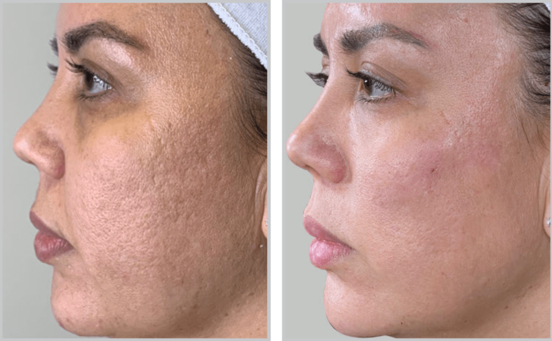 Halo Hybrid Fractional Laser