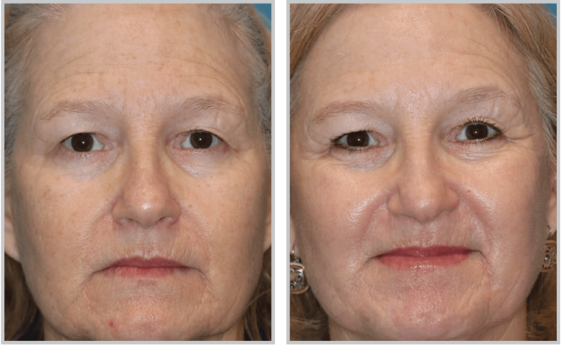 Halo Hybrid Fractional Laser