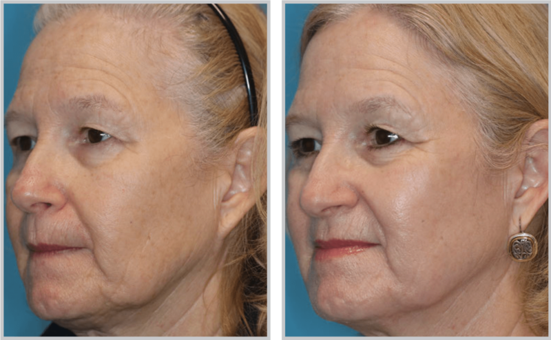 Halo Hybrid Fractional Laser