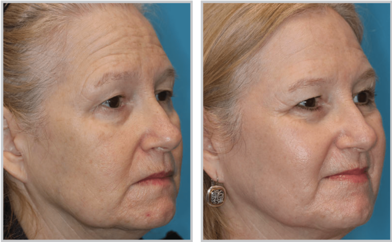 Halo Hybrid Fractional Laser