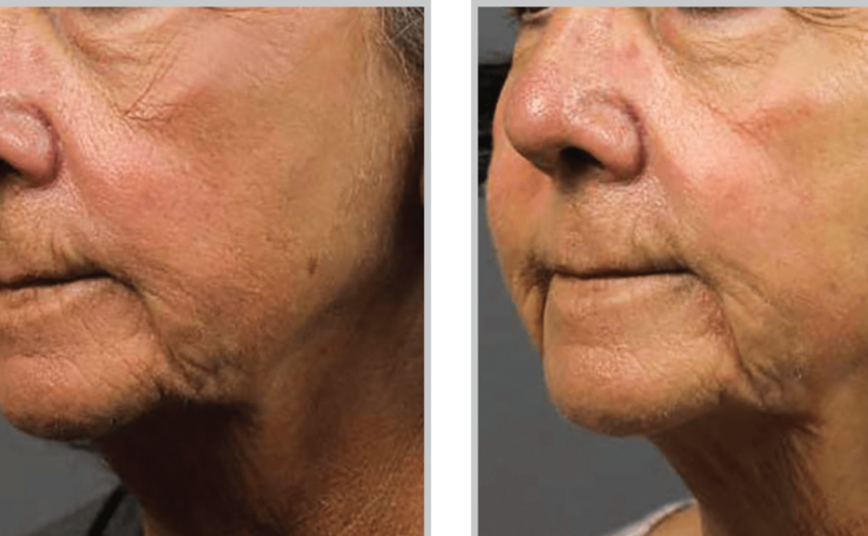 Halo Hybrid Fractional Laser