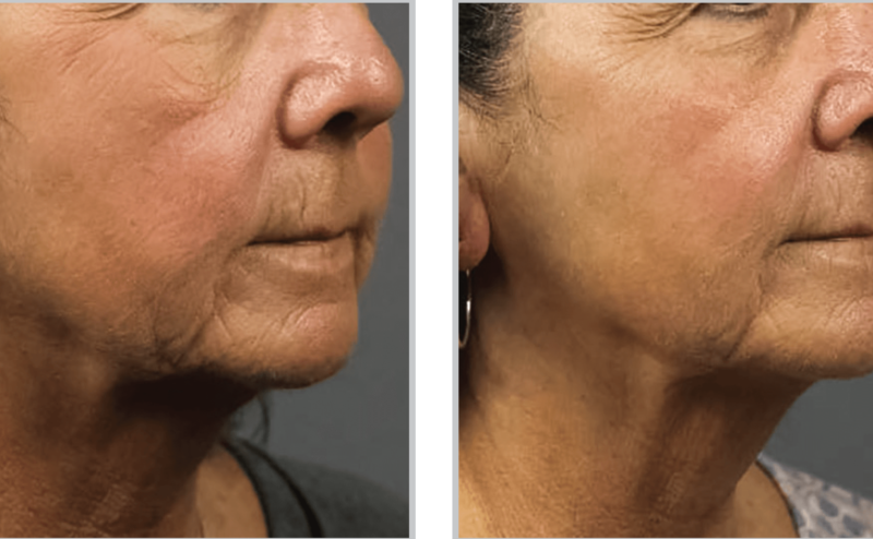 Halo Hybrid Fractional Laser