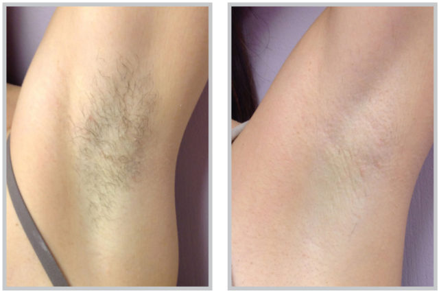 Laser Hair Removal BARE HR