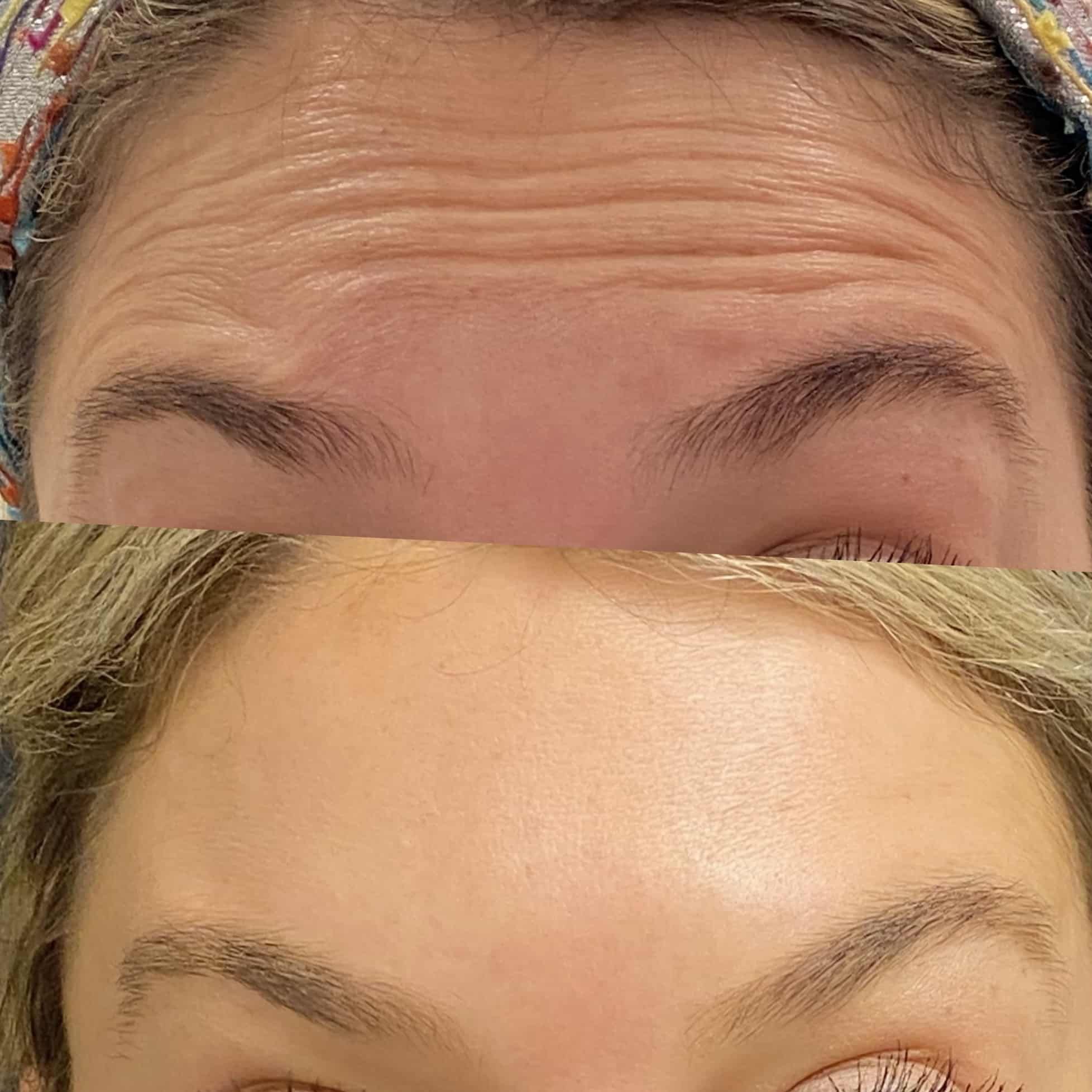 Botox