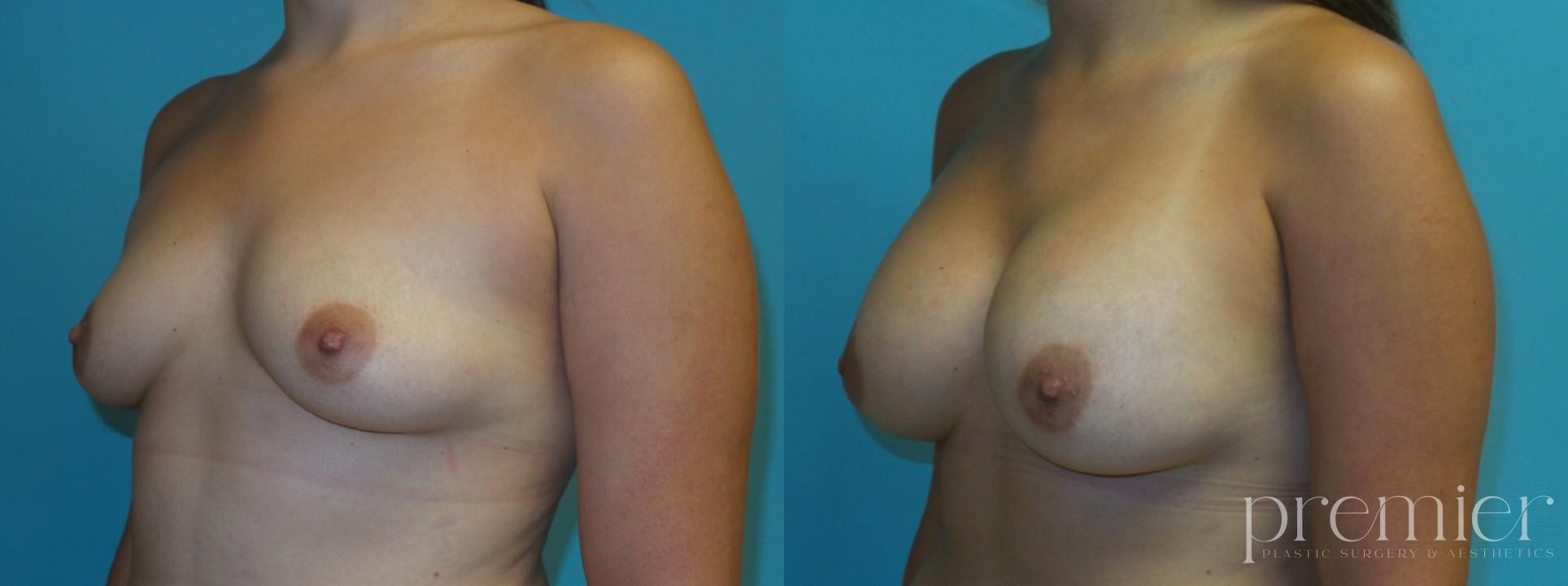 Breast Augmentation7