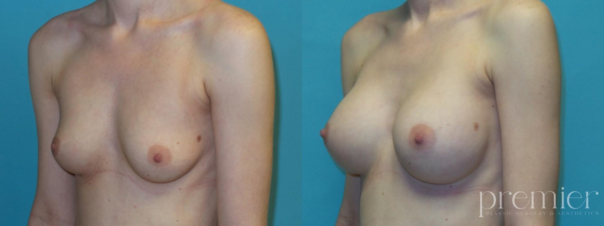 Breast Augmentation8