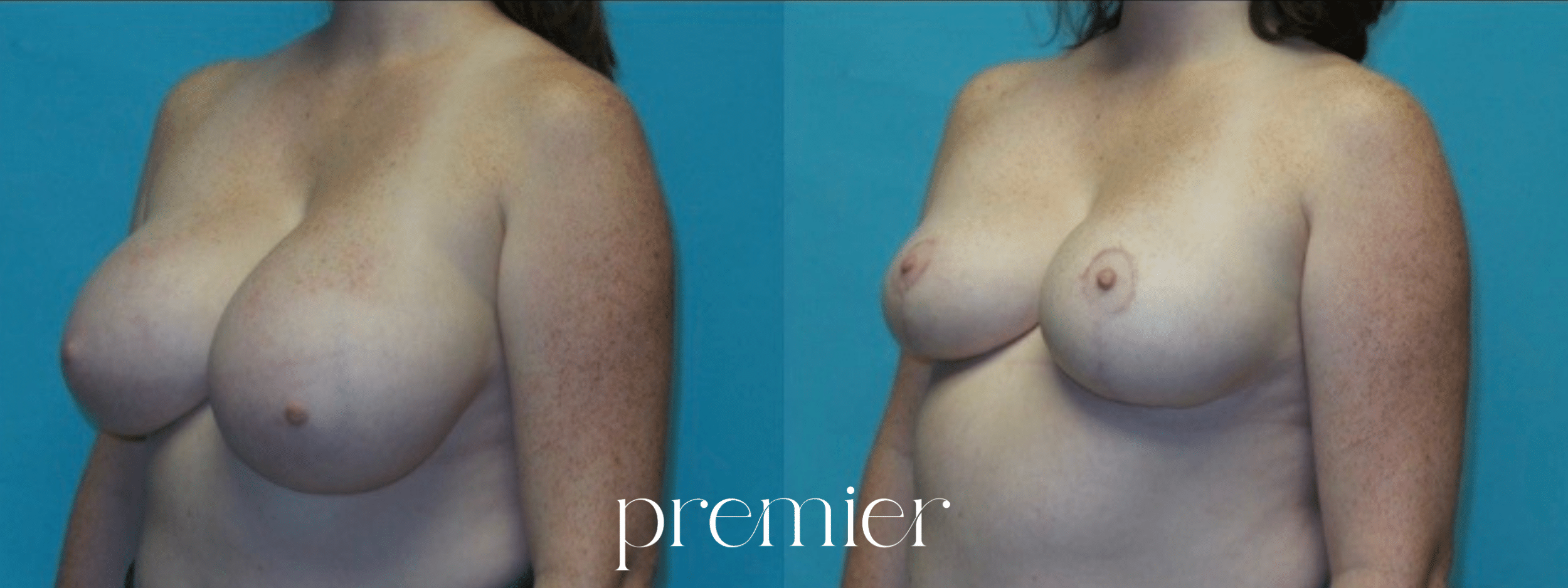 Breast Reduction