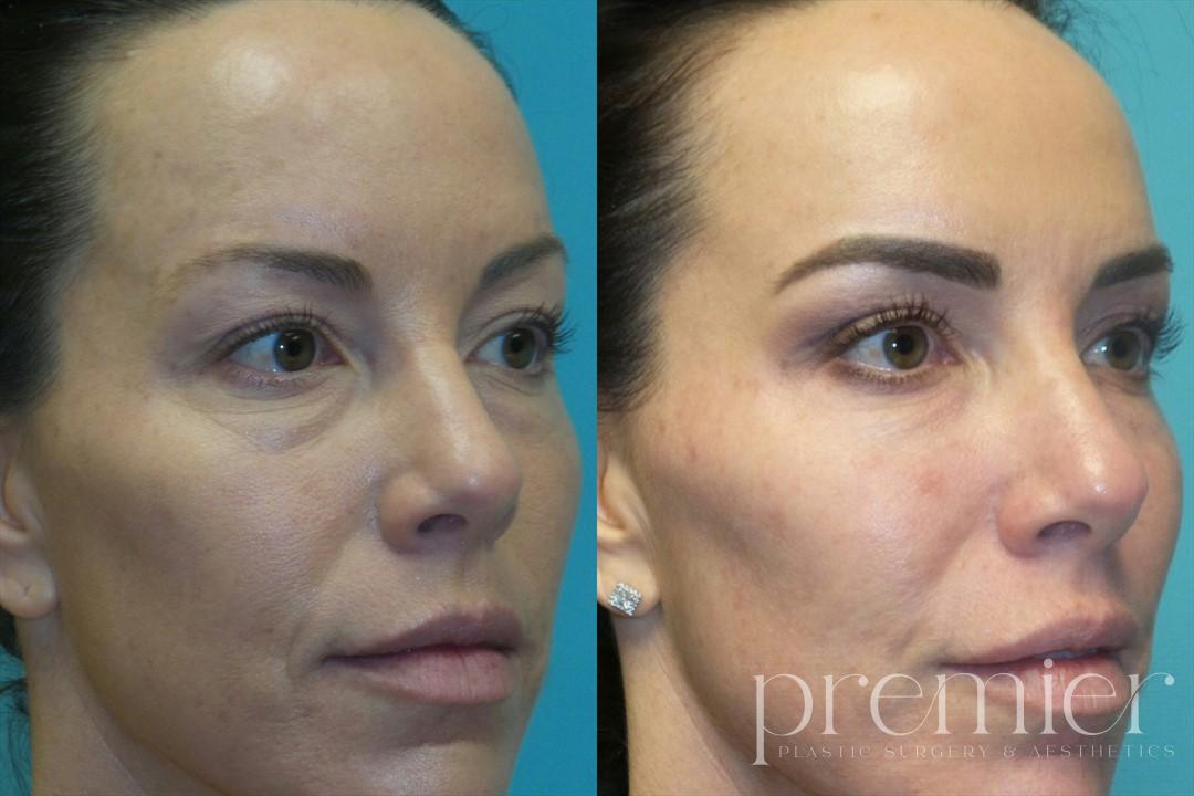 Cheeks Tear Troughs