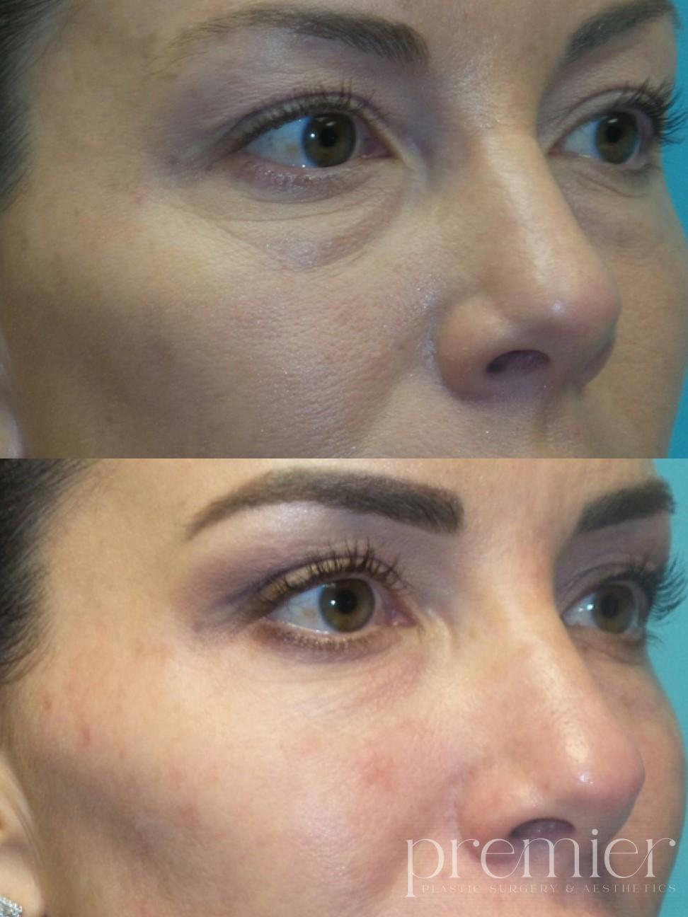 Cheeks Tear Troughs1