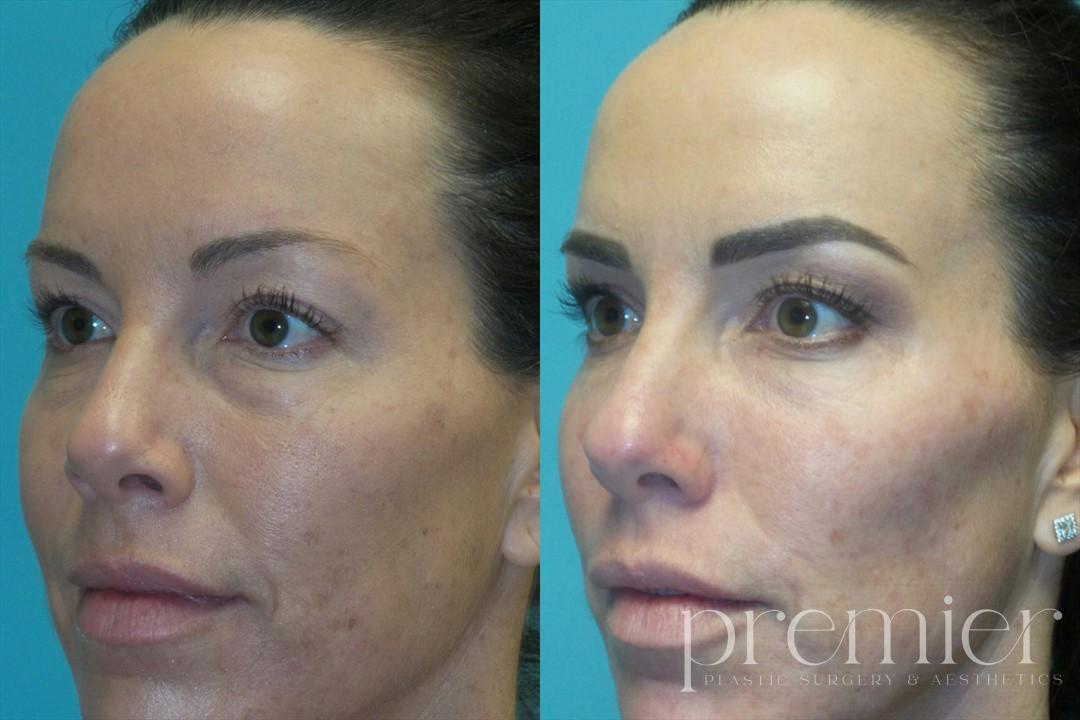 Cheeks Tear Troughs2