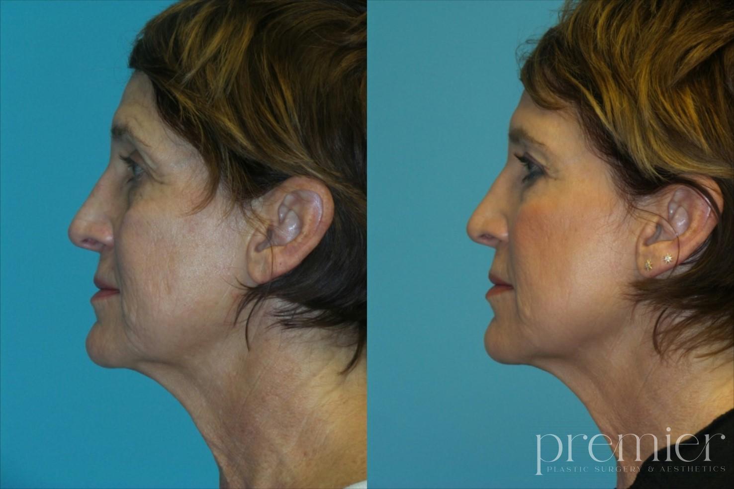 Face Neck2